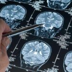 Erkeklerde gizlenmiş tehlike! Alzheimer'ın araştırmasında, genetik varyantın demans riskini arttırdığı keşfedildi: bu varyantlı erkeklerde gelişme riskinin 2.39